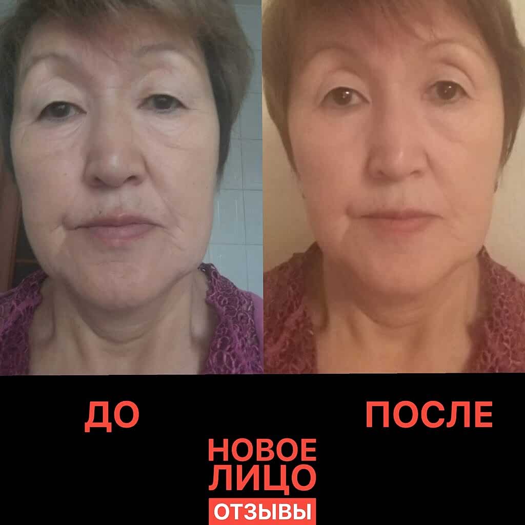 омоложение лица