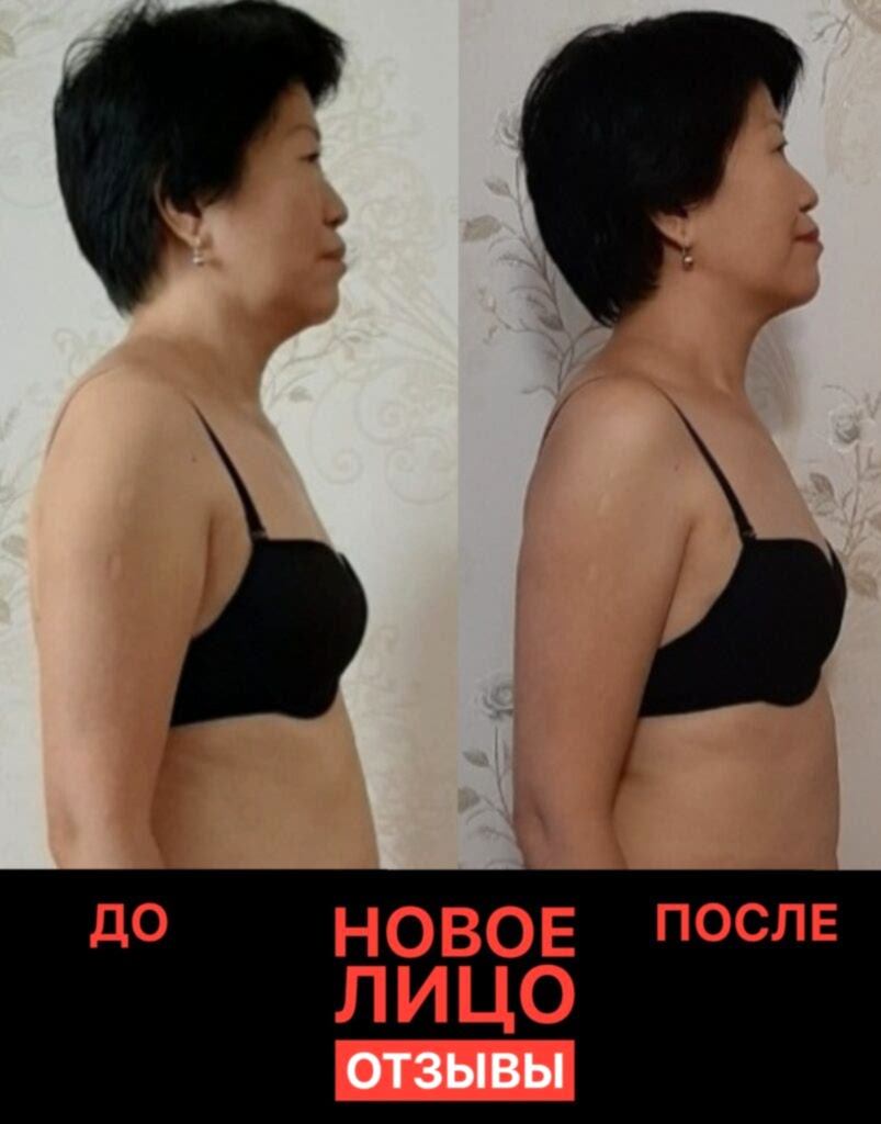 омоложение лица